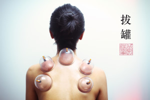 cupping therapy acupuncture brisbane