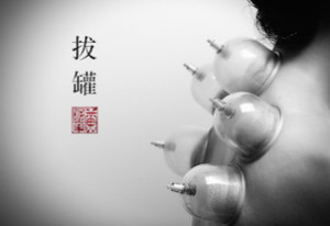 cupping therapy acupuncture Brisbane