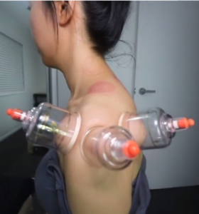 cupping for shoulder pain relief