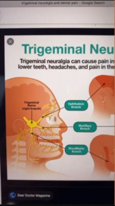 trigeminal neuralgia and neck pain