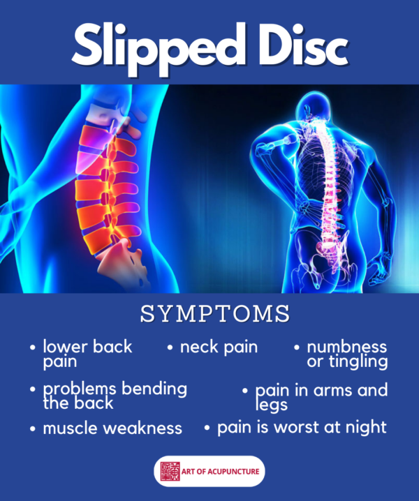 Slipped Disc Symptoms - Art of Acupuncture